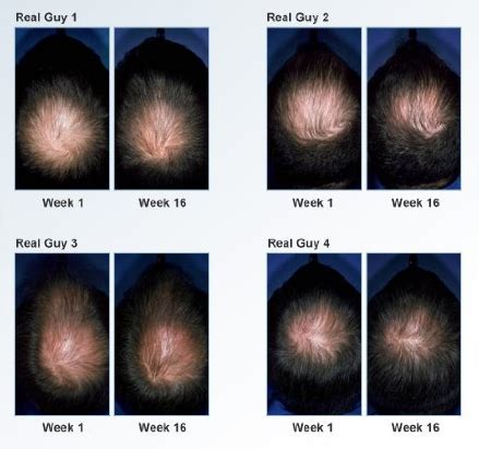 biotin 10000 mcg hair growth before and after|Biotin Hair Growth Before and After Pictures: The .